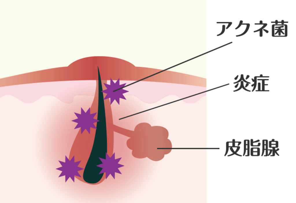 医療脱毛ができないニキビ