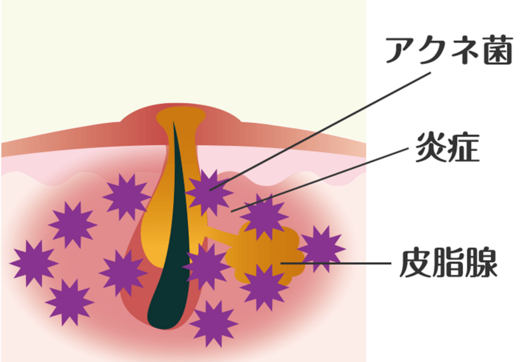 医療脱毛ができないニキビ