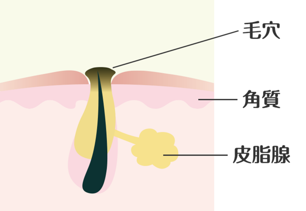 医療脱毛ができるニキビ