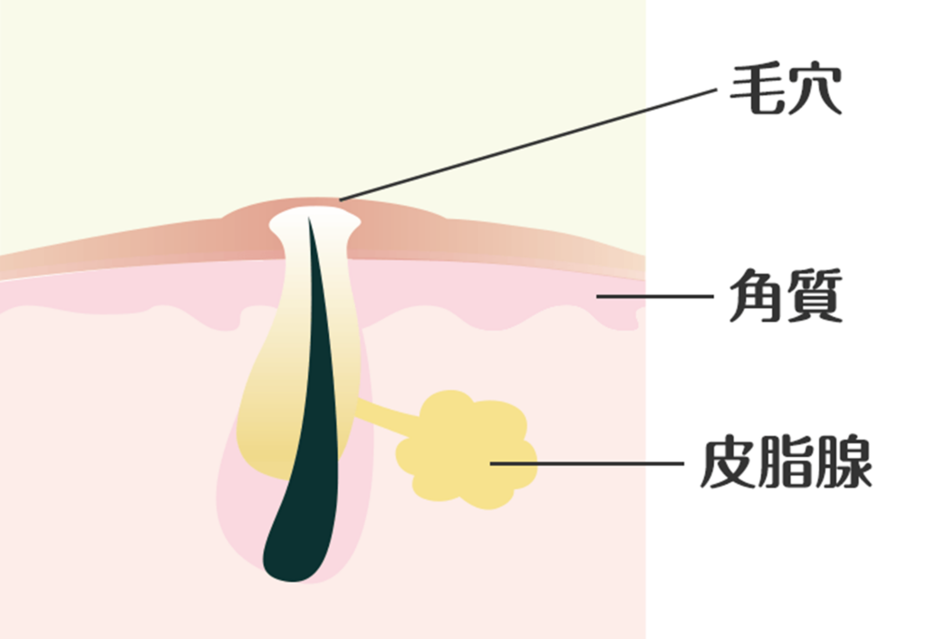 医療脱毛ができるニキビ