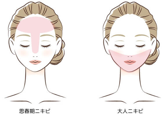 思春期ニキビと大人ニキビ
