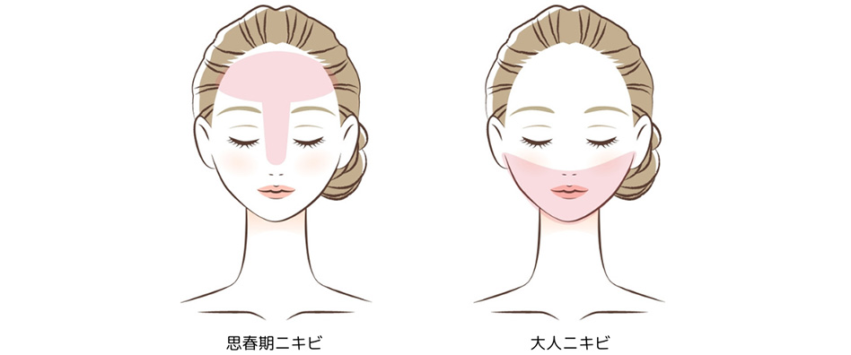 思春期ニキビと大人ニキビ