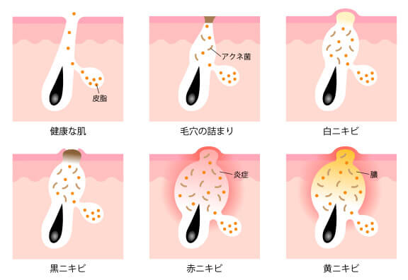 ニキビの進行過程