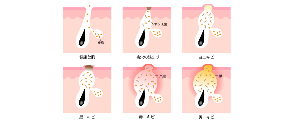思春期ニニキビの進行過程キビと大人ニキビ
