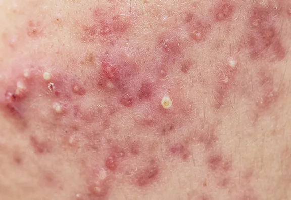 嚢胞性ニキビで真皮が破壊される