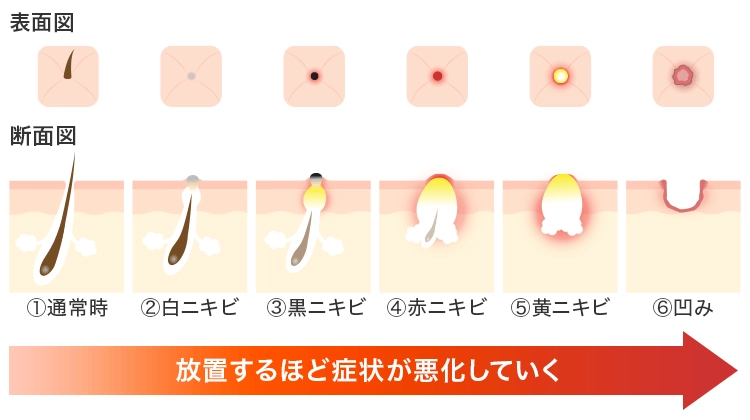 ニキビの進行