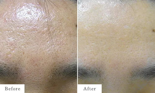 PRP治療（再生治療）のbefore after