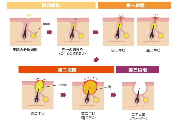 ニキビの段階と症状