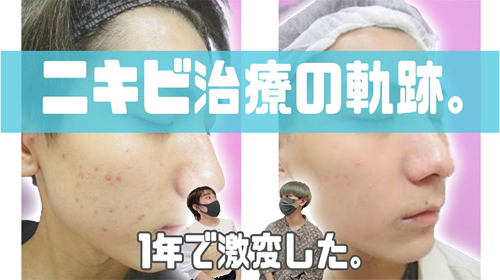 ニキビ治療を受けた方の声を聞きたい方はコチラ!