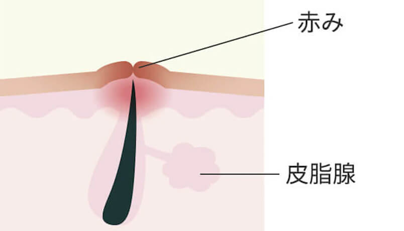 赤みが残るニキビ跡