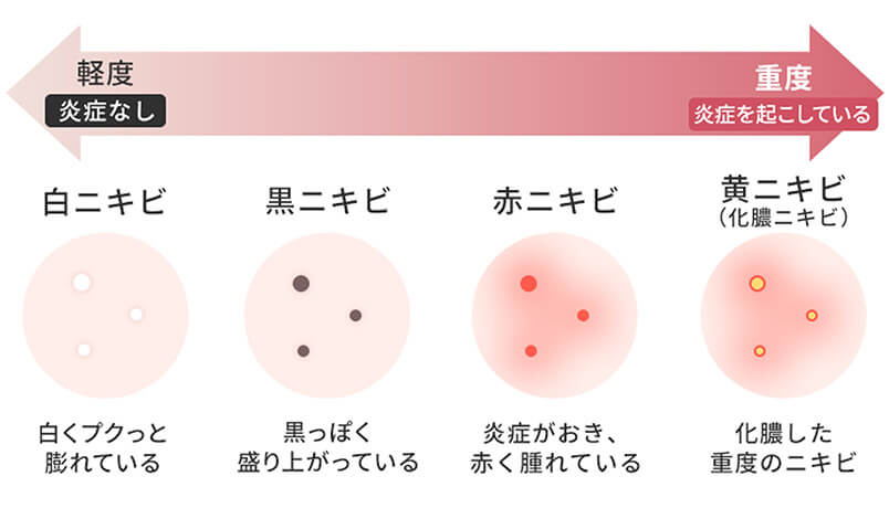 ニキビの種類