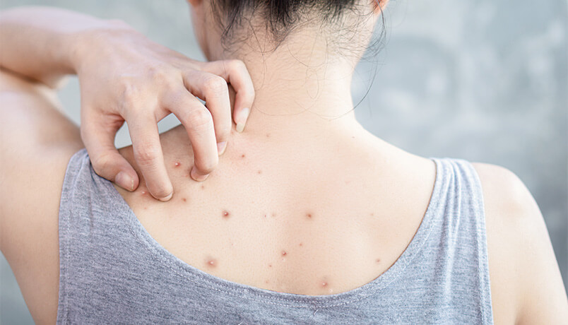背中のニキビは触らない・潰さない