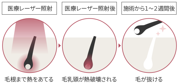 医療脱毛とは?