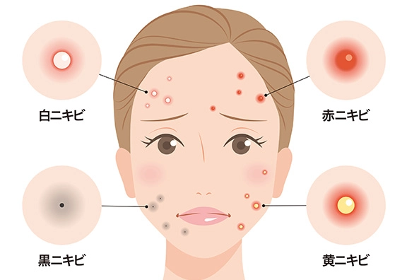 ニキビができやすい肌のケア