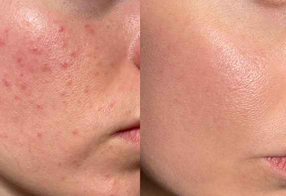 ニキビ跡の赤みへのアプローチ