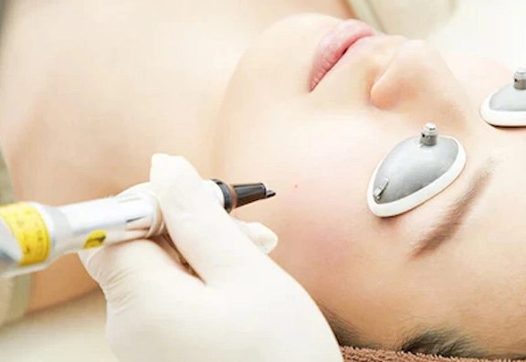 アブレージョン