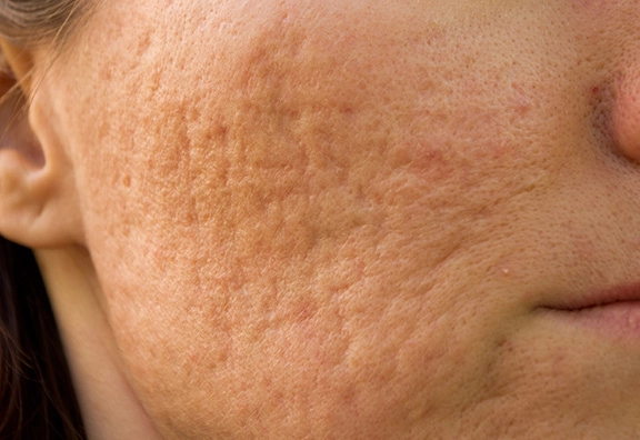 クレーター肌への効果