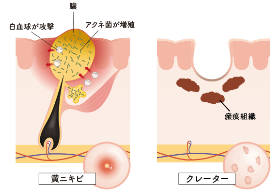 クレーターになる仕組み