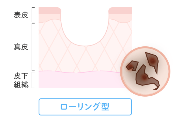 ローリング型クレーター