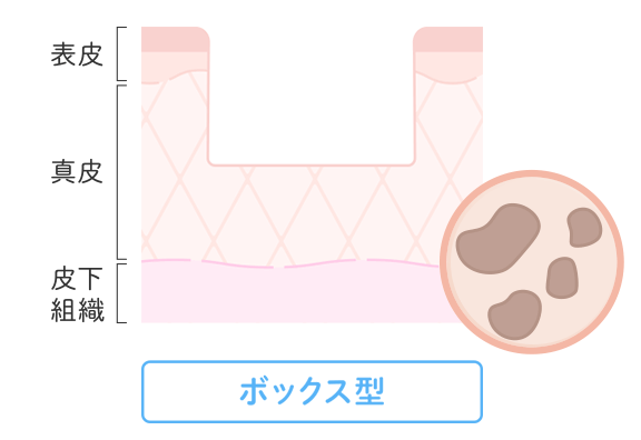 ボックス型クレーター