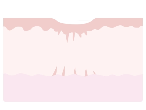 ③線維が切れ、へこみが改善します