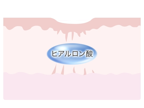 ④ヒアルロン酸などを注入して再癒着を防ぎます