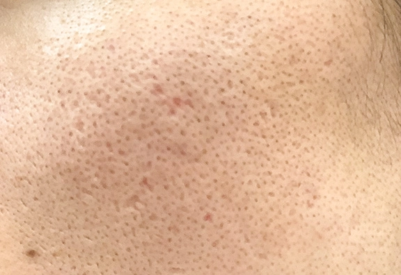 アイスピック型