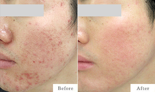 イソトレチノイン（イソトロイン）療法のbefore after