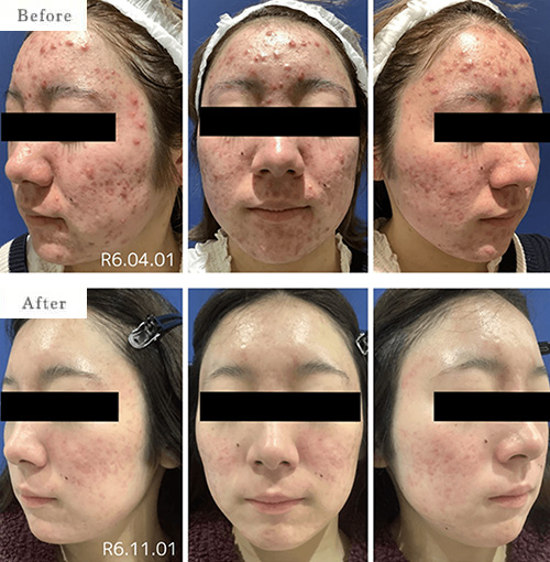 ケミカルピーリング・イソトレチノイン（イソトロイン）療法のbefore after