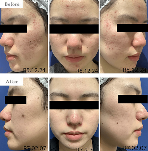 ケミカルピーリング・イソトレチノイン（イソトロイン）療法のbefore after