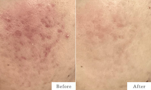 ケミカルピーリング・光線治療・イソトレチノイン（イソトロイン）療法のbefore after