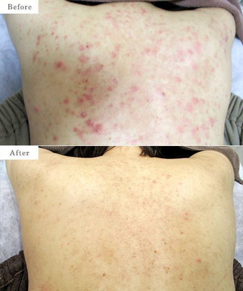 ケミカルピーリング・光線治療のbefore after